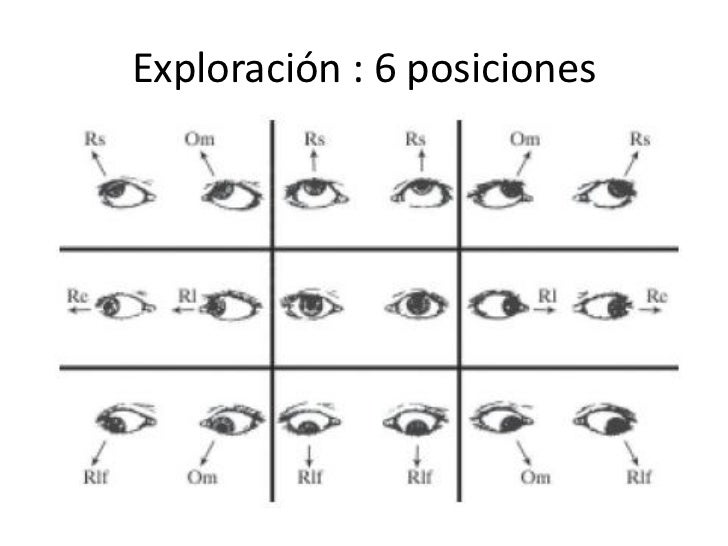 Caso clínico de Diplopia