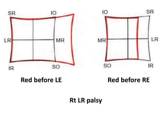 Red before RERed before LE
Rt LR palsy
 