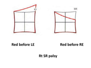 Red before LE Red before RE
Rt SR palsy
 