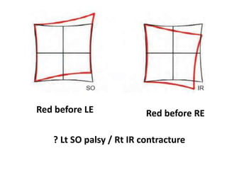 Red before LE Red before RE
? Lt SO palsy / Rt IR contracture
 