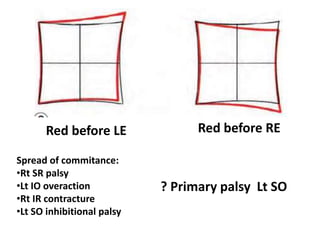 Red before LE Red before RE
Spread of commitance:
•Rt SR palsy
•Lt IO overaction
•Rt IR contracture
•Lt SO inhibitional palsy
? Primary palsy Lt SO
 