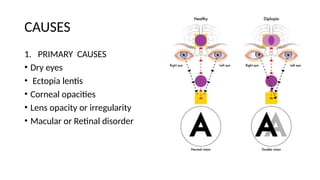 DIPLOPIA in Oral and Maxillofacial trauma.pptx