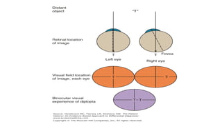 DIPLOPIA in Oral and Maxillofacial trauma.pptx