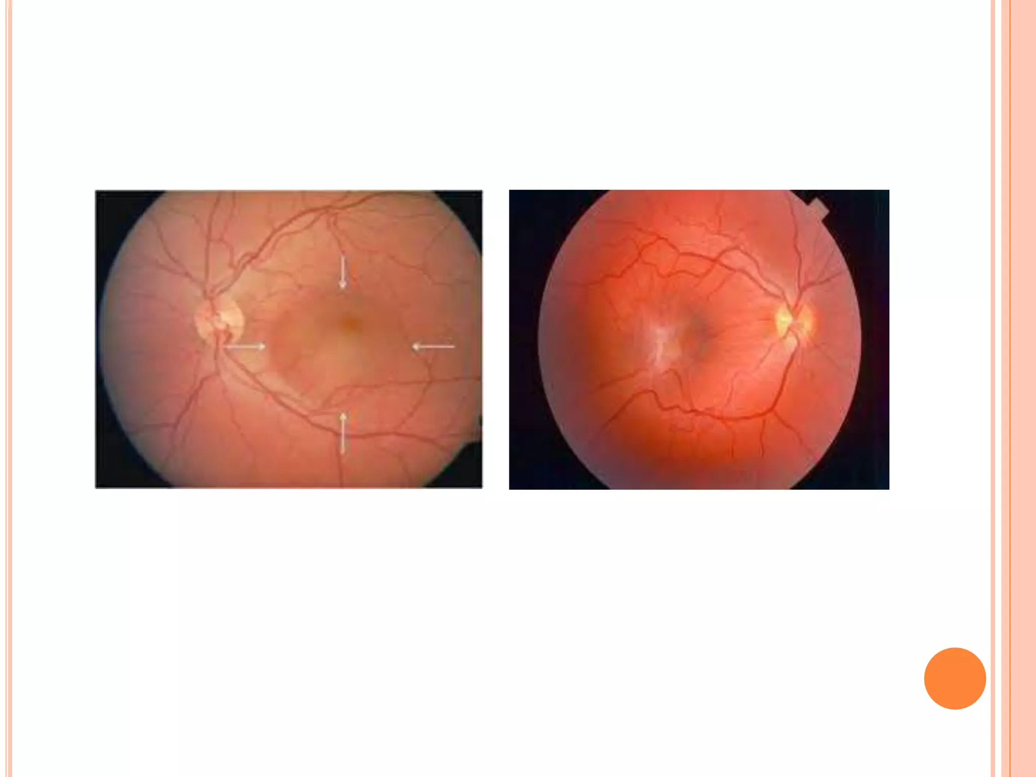 Diplopia approach PPT