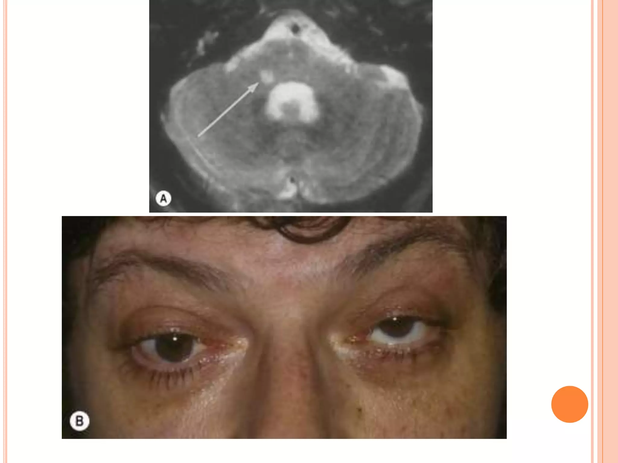 Diplopia approach | PPT