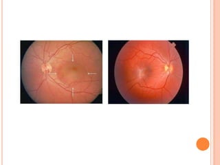 Diplopia approach | PPTX