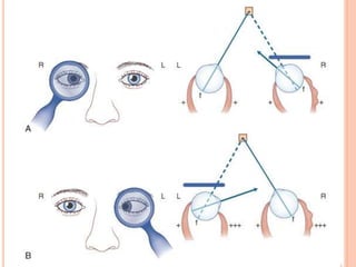 Diplopia approach | PPTX