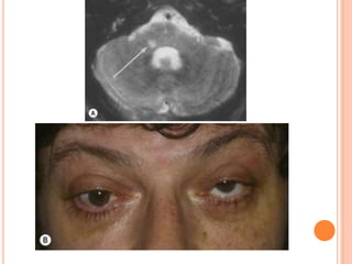 Diplopia approach | PPTX