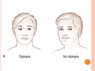Diplopia approach | PPTX