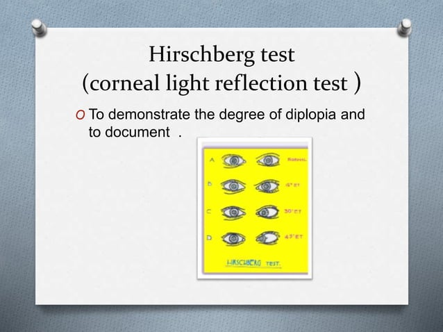 Diplopia by yugandhar tummala | PPTX | Eye and Vision Conditions ...