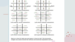 diplopia charting.ppt diplopia charting | PPTX
