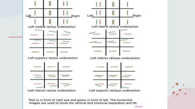 Diplopia Types diplopia charting.ppt diplopia charting | PPTX | Eye and Vision ...