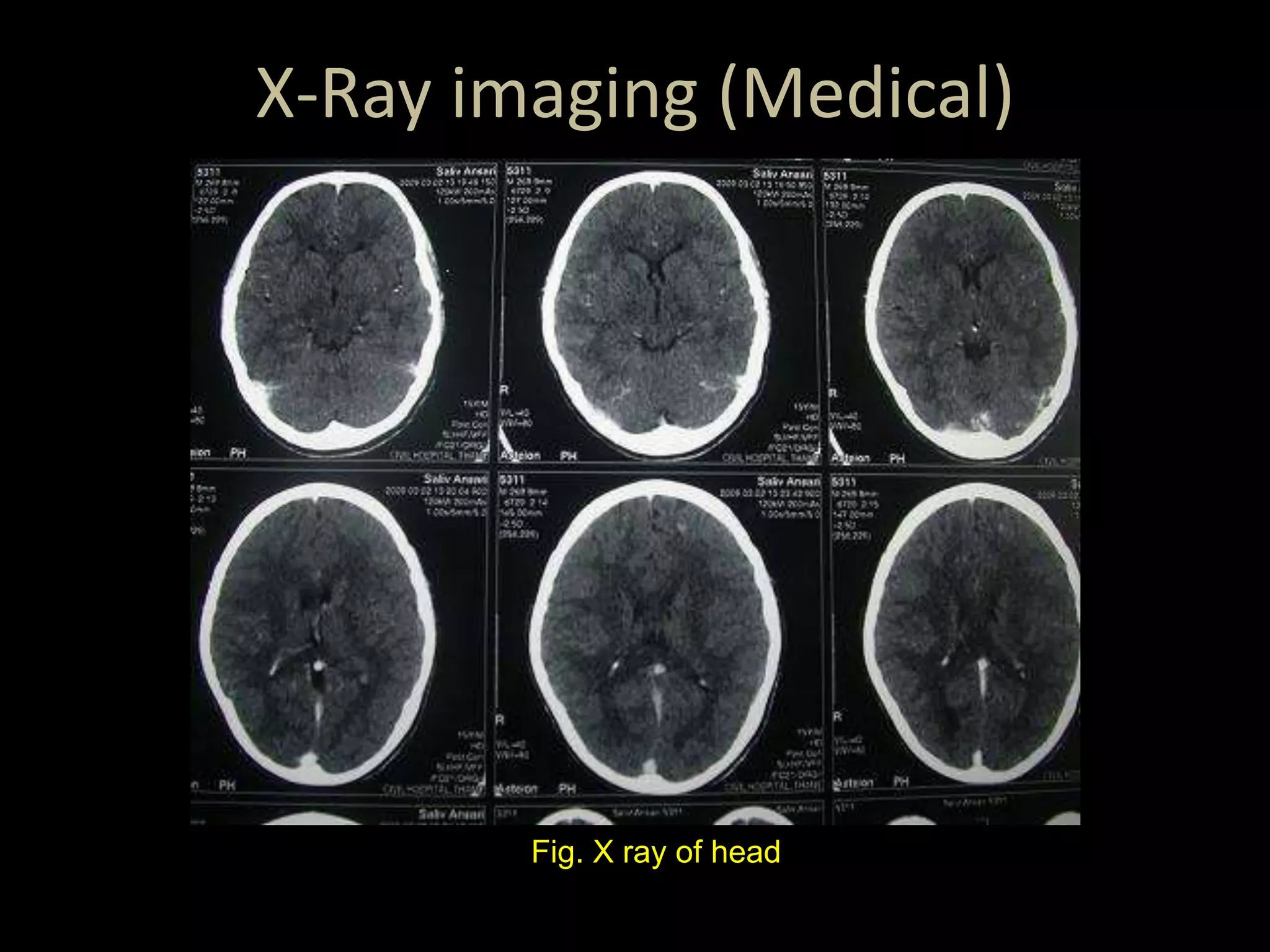 X-Ray imaging (Medical)
Fig. X ray of head
 