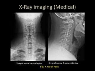 X-Ray imaging (Medical)
Fig. X ray of neck
 