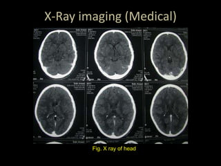 X-Ray imaging (Medical)
Fig. X ray of head
 