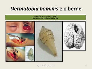 Dermatobia hominis e o berne
18Diptera: Cyclorrapha - moscas
Diagnóstico: clínico (visual)
Tratamento: retirada da larva.
 