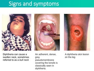 Diphtheria Bull Neck Diphtheria Bull Neck