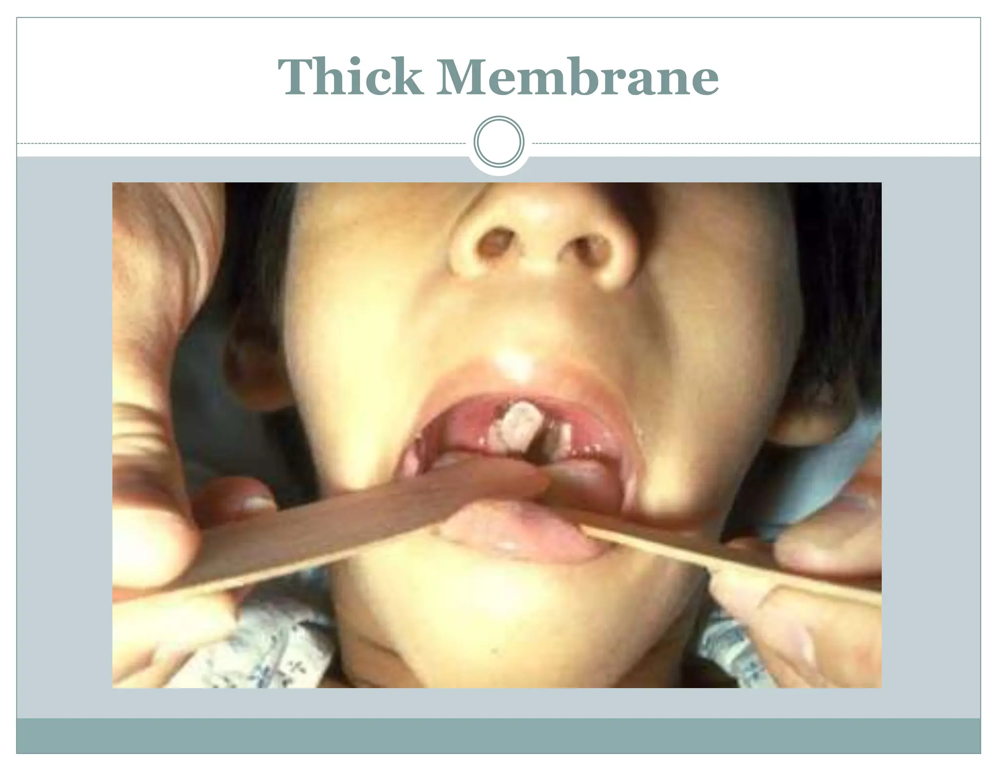 Thick Membrane
 