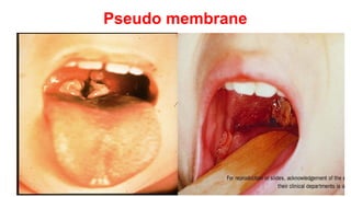 Pseudo membrane
 