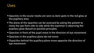Uses
 Opacities in the ocular media are seen as dark spots in the red glow at
the pupillary area.
 The plane of the opacities can be assessed by asking the patient to
move the eye from side to side while the examiner is observing the
pupillary glow (based on parallax principle).
 Opacities in front of the pupil move in the direction of eye movement.
 Opacities in the pupillary plane do not move.
 Ospacities behind the pupillary plane move opposite the direction of
eye movement.
 