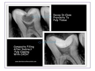 Direct and indirect pulp capping | PPTX