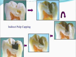 Direct and indirect pulp capping | PPTX