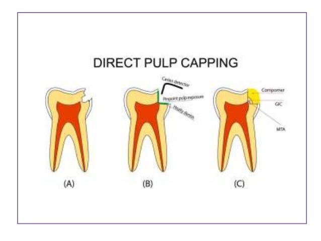 direct and indirect pulp capping direct pulp capping