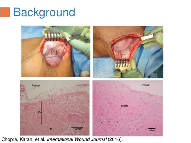 Direct to Implant Prepectoral Breast Reconstruction