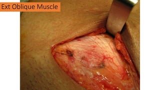 Ext Oblique Muscle
 