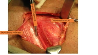 Ext Oblique reflected
Conjoined Muscle
 