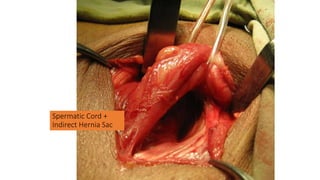 Spermatic Cord +
Indirect Hernia Sac
 