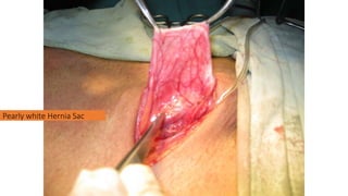 Pearly white Hernia Sac
 