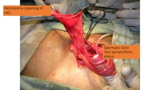 Herniotomy (opening of
sac)
Spermatic Cord
Vas/ pampiniform
plexus
 
