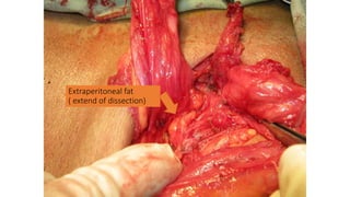 Extraperitoneal fat
( extend of dissection)
 