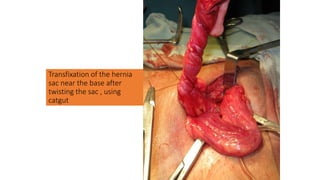 Transfixation of the hernia
sac near the base after
twisting the sac , using
catgut
 