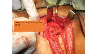 Lax porterior wall of inguinal
canal
 