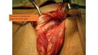 Plication of posterior
inguinal canal wall
 