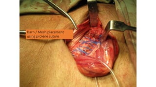 Darn / Mesh placement
using prolene suture
 