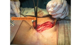 Closure of External oblique
 