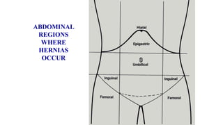 ABDOMINAL
REGIONS
WHERE
HERNIAS
OCCUR
 