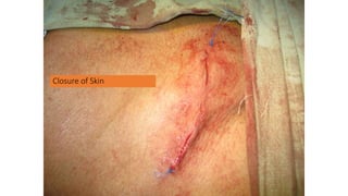 Closure of Skin
 