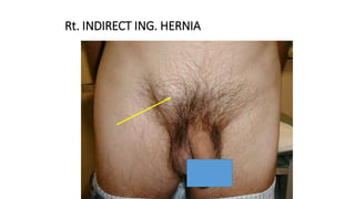 Rt. INDIRECT ING. HERNIA
 