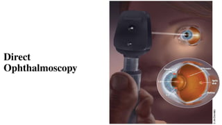 Direct
Ophthalmoscopy
 