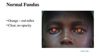 Normal Fundus
• Orange – red reflex
• Clear, no opacity
Source - flickr
 