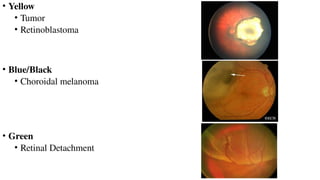 • Yellow
• Tumor
• Retinoblastoma
• Blue/Black
• Choroidal melanoma
• Green
• Retinal Detachment AAO - Retinoblastoma
 