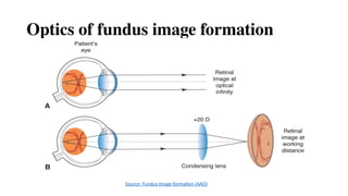 Optics of fundus image formation
Source- Fundus Image formation (AAO)
 