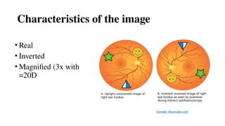 Characteristics of the image
• Real
• Inverted
• Magnified (3x with
=20D
Eyewiki- Biorender.com
 
