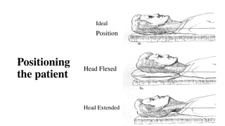 Positioning
the patient
Ideal
Position
Head Flexed
Head Extended
 