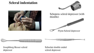 Schepens scleral depressor (with
thimble)
Schocket double ended
scleral depressor
Josephberg Besser scleral
depressor
Flynn Scleral depressor
Scleral indentation
 