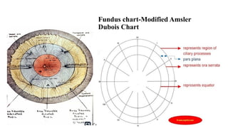 Fundus chart-Modified Amsler
Dubois Chart
 
